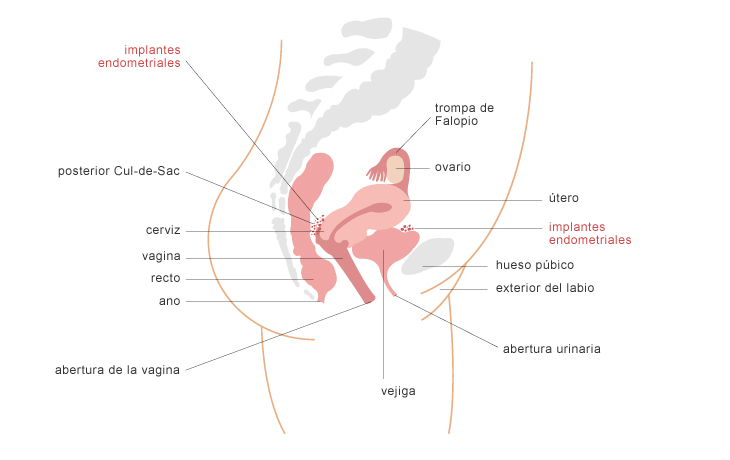 endometriosis-spanish