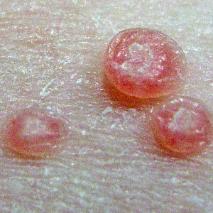 Molluscum Contagiosum