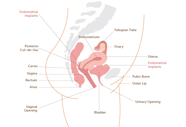 Endometriosis All Guides Center For Young Women S Health