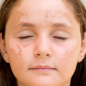 girl with facial discoloration