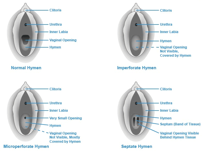 Hymens: Types of Hymens | Center for Young Women's Health