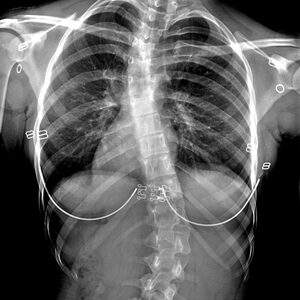 scoliosis