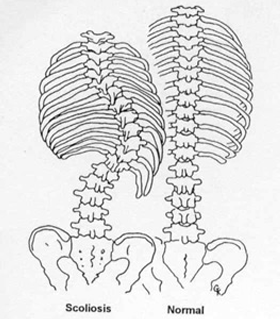 Scoliosis vs. normal spine