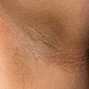 acanthosis nigricans