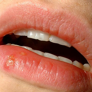 oral herpes