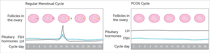 regelmæssig vs. PCOS menstruationscyklus
