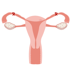 tubal ligation sterilization female