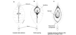 labial adhesions