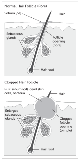 Normal vs clogged hair follicle